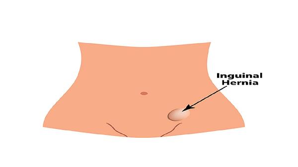 食管裂孔疝治疗前的注意事项