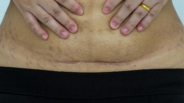 瘢痕妊娠最佳流产时间