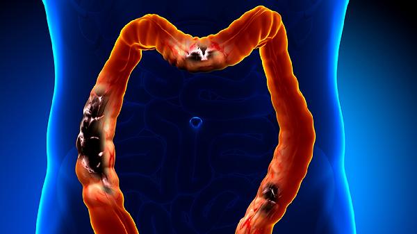 大肠黏液癌早期症状有哪些