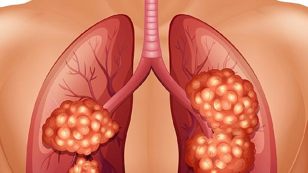 唾液酸是筛查什么肿瘤