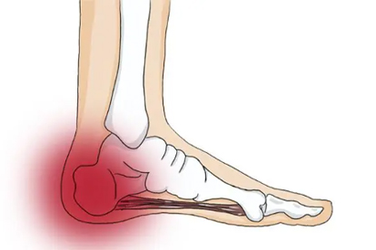 足跟痛少走路能自愈吗