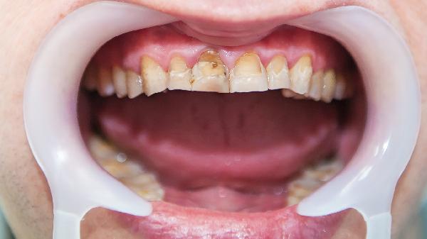 牙龈没有血色怎么回事