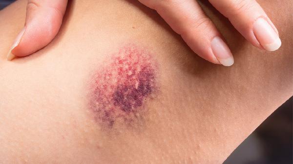 海洋创伤弧菌的感染原因有哪些