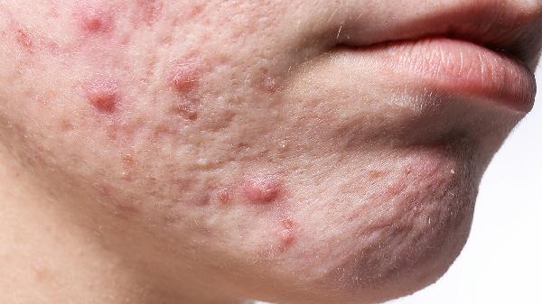 毛孔粗大可以激光治疗吗 激光能去痘痕吗