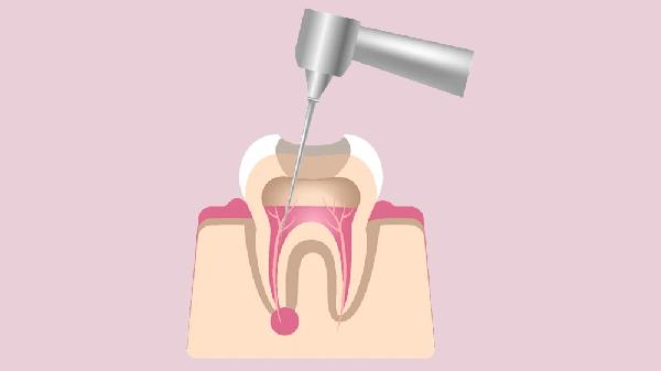 龋齿发展到什么程度进行根管治疗