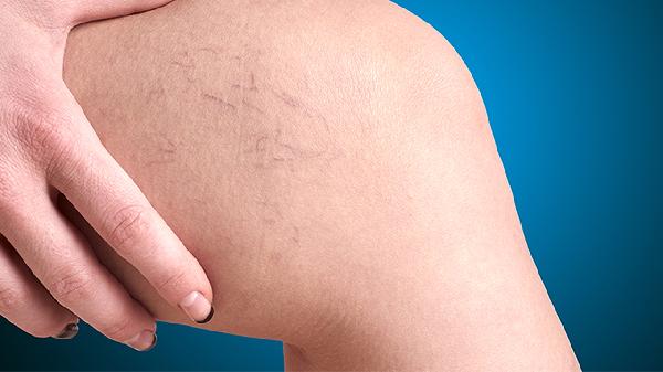 测血糖指血与静脉血差别大吗