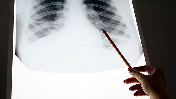 肺3mm微小结节边界较清晰