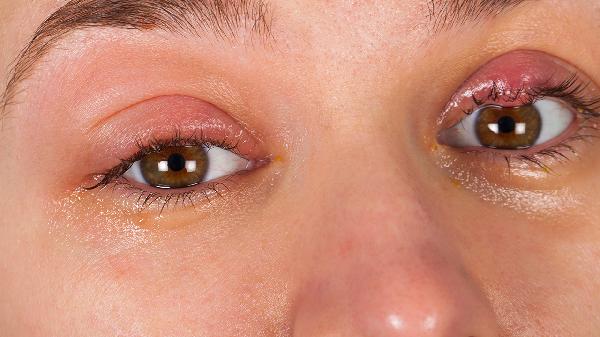 霰粒肿吃什么食物