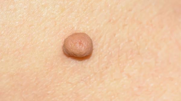 结核菌素皮肤试验禁忌人群