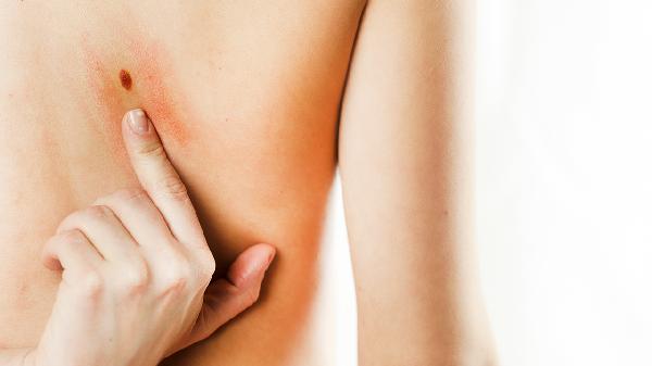 神经纤维瘤切除后还会复发吗