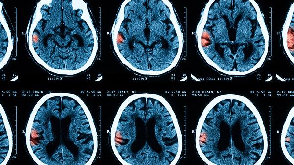 钛网颅骨修补失败案例有哪些