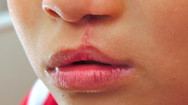 唇裂的修复治疗方法有哪些 唇裂的几个修复方法介绍