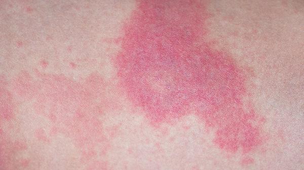 儿童血小板减少性紫癜需要做b超吗