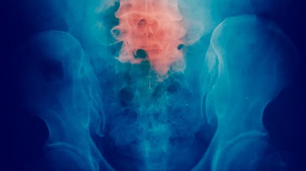 做肾上腺肿瘤术粘连怎么办