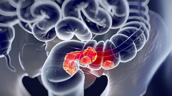 小肠瘘是怎么引起的 这几个原因会导致小肠瘘