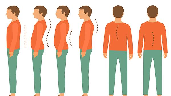 强直性脊柱炎严重能控制吗