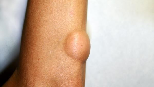 脂肪瘤切除术注意事项有哪些 盘点脂肪瘤切除后的四个注意事项