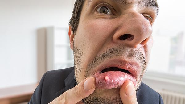 孩子嘴里老是起溃疡是怎么回事