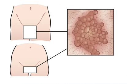 尖锐湿疣激光治疗的适应症是什么