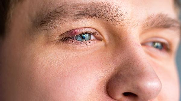 麦粒肿一个月了还不好怎么办