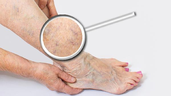 痛风的物理治疗方法有哪些