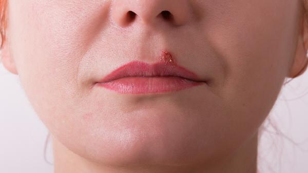 什么是口角炎 口角炎会传染吗