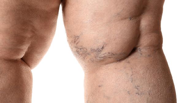 大腿受伤后淤血水肿怎么处理