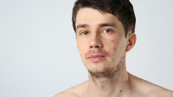 蜘蛛痣是怎么产生的 蜘蛛痣发生与两个因素有关