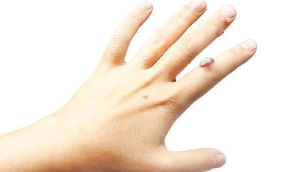 治疗尖锐湿疣好的方法