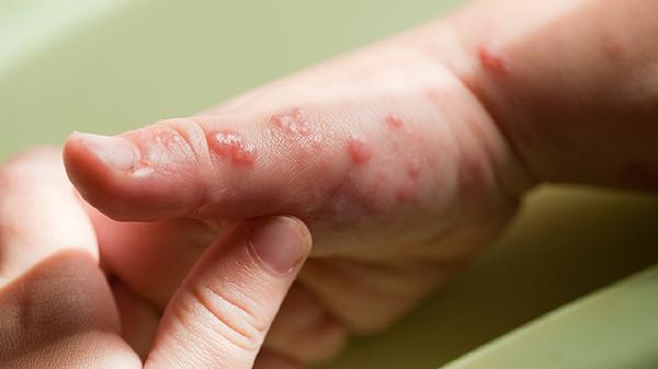 疱疹性咽峡炎血常规能检查出来吗