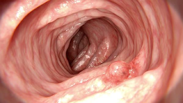 女性前庭大腺囊肿症状