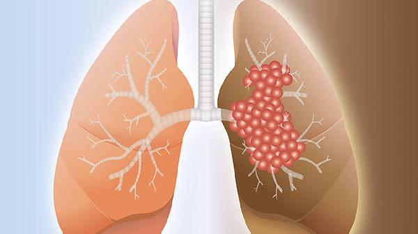 左肺下叶外基底段小结节怎么办