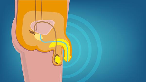 睾丸一侧肿大怎么回事 睾丸一侧肿大的常见原因须知