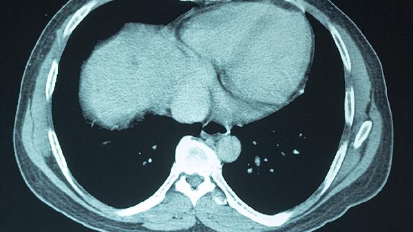 哪些原因可以引起颅内压升高 引起颅内压升高的4个原因揭晓