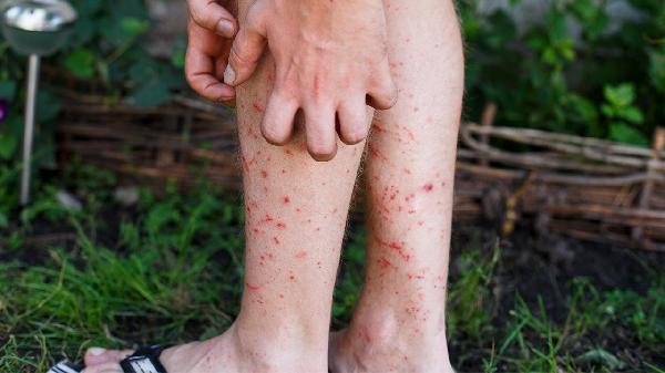 小儿血小板减少紫癜恢复期需注意什么