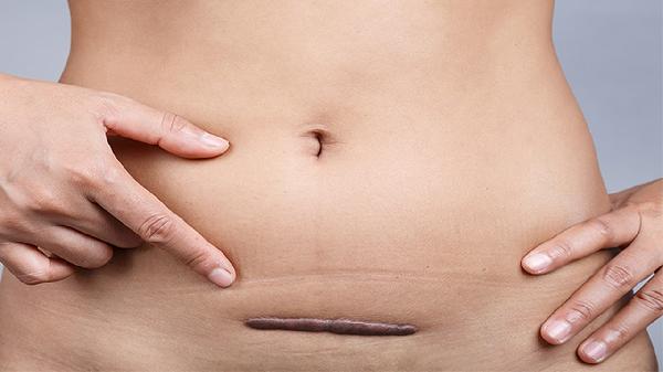 怎么判断是不是增生性瘢痕