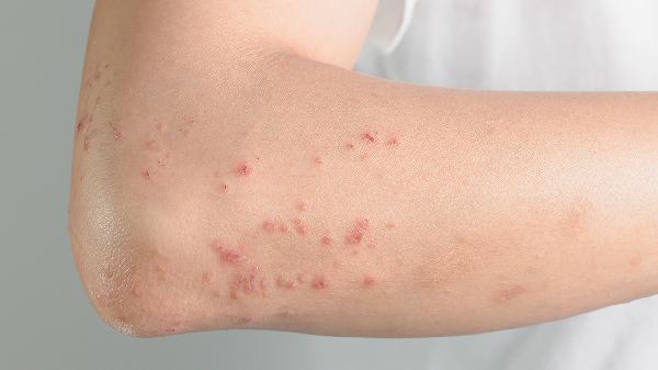 进行性色素性紫癜性皮炎多久能好