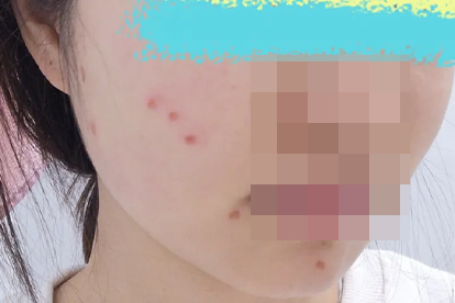 包皮手术结痂怎么快速掉落