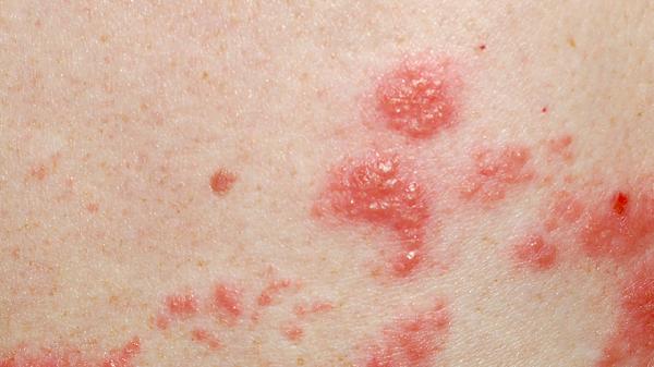 免疫缺陷会影响艾滋病抗体产生吗