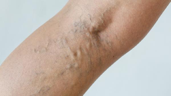 淋巴清扫后手臂水肿怎么办