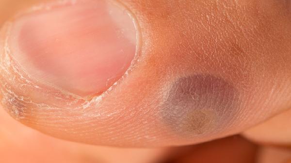 尖锐湿疣的早期症状有哪些