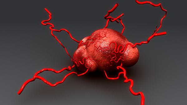 睑板腺囊肿怎么好得快 睑板腺囊肿的快速治愈方法介绍