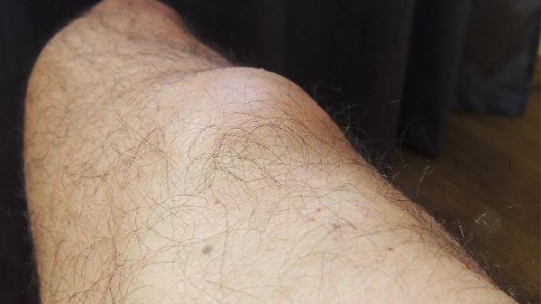 软组织脂肪瘤怎么回事 怎么办