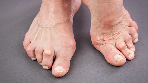 痛风结节和痛风石是一回事吗