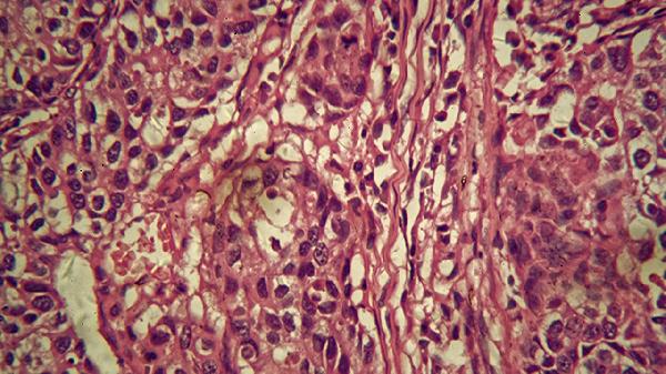 淋巴细胞百分比58正常吗