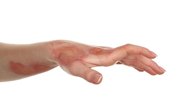 心肌脓肿患者如何做好饮食调养