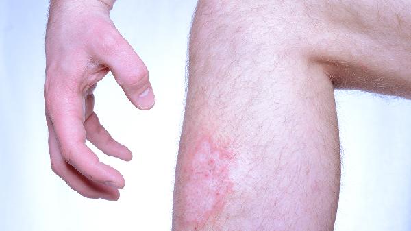 阳光过敏性皮肤病怎么治愈