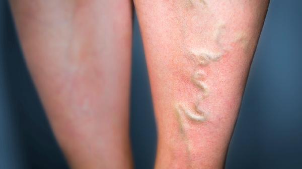 甲泼尼龙造成浮肿怎样消除