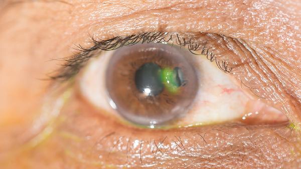 眼睛往下看模糊是什么原因