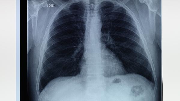 鼻咽癌肺转移的症状主要有哪些